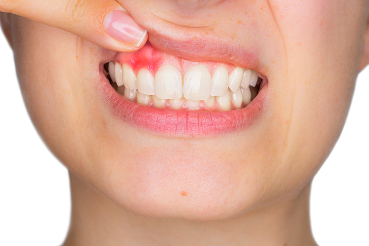 DentaFend Capsules - How to Cure Gum Disease?